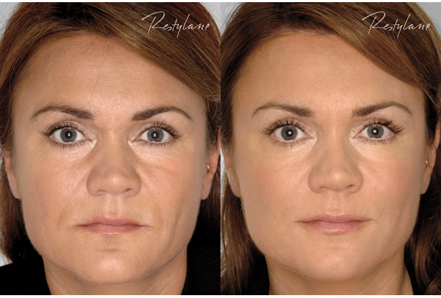 Rynkbehandling med fillers | Före- och efterbilder