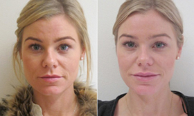 stureklinikenjohannabeforeafter