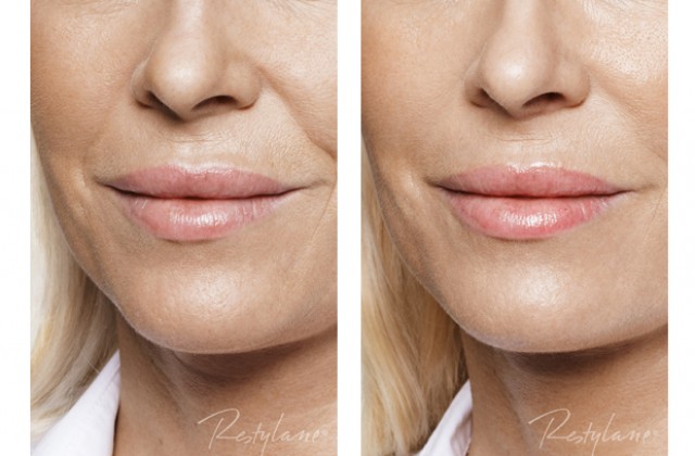 fillers nasolabialveck pris