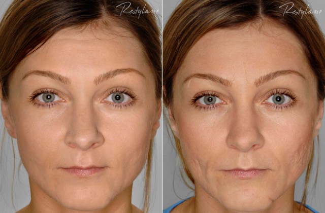 Fillers/Restylane