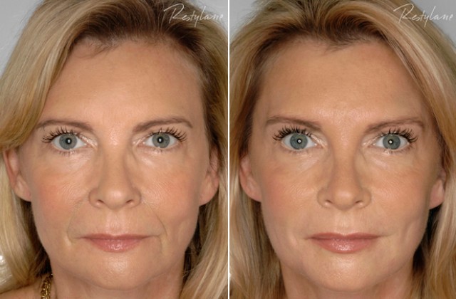fillers före efter fillers före efter