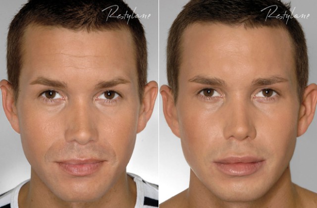 fillers i pannan fillers i pannan