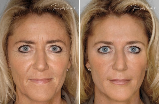 rynkor i pannan fillers rynkor i pannan fillers
